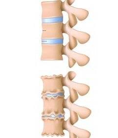 coloană vertebrală sănătoasă și coloană afectată de osteocondroză