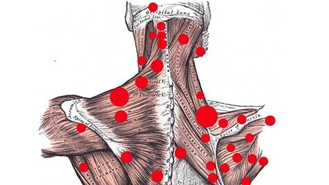 Punctele declanșatoare ale mușchilor care provoacă dureri de spate miofasciale