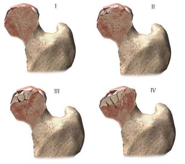 etapele de artroză a articulației șoldului