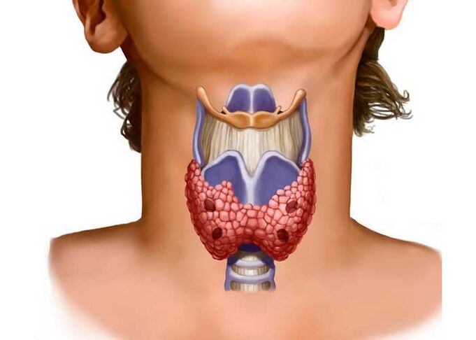 probleme cu tiroida ca o cauză a durerii de gât