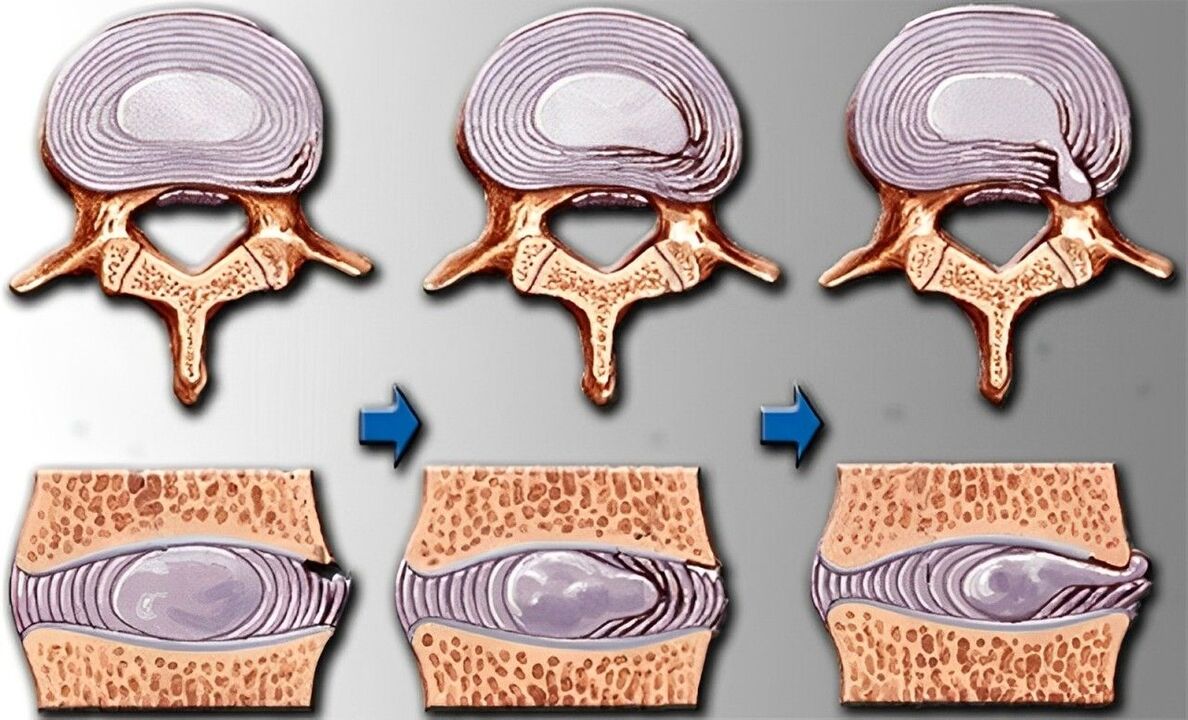 stadiile osteocondrozei