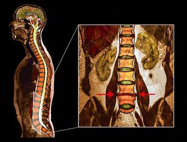 Disc degenerativ în coloana vertebrală