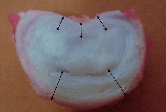 cum arată un disc intervertebral
