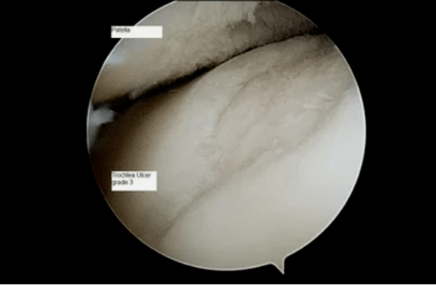 Vedere astroscopică a unei articulații a genunchiului cu artroză de gradul 3