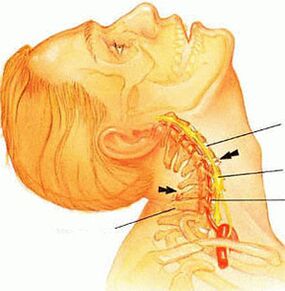Osteocondroza coloanei cervicale
