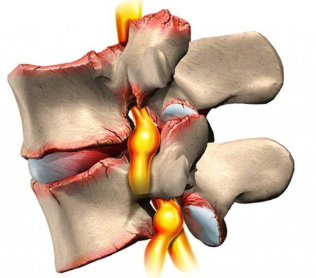 Osteochondrosis a coloanei vertebrale